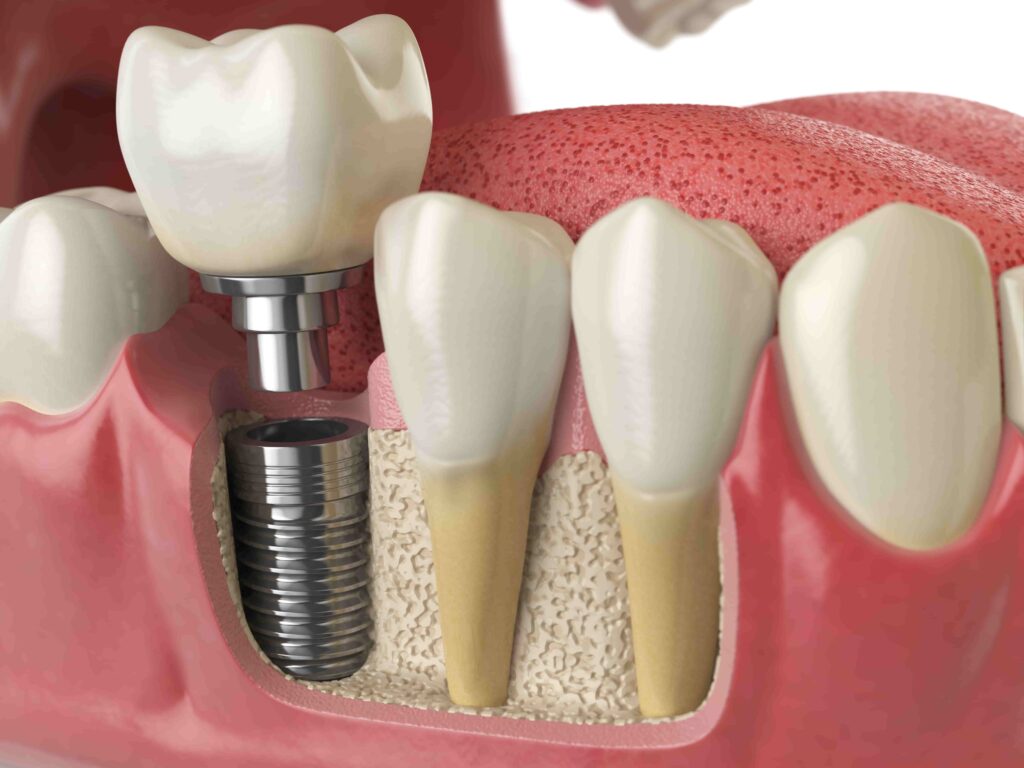 Dental Impalnt In maju s2 dental clinic
