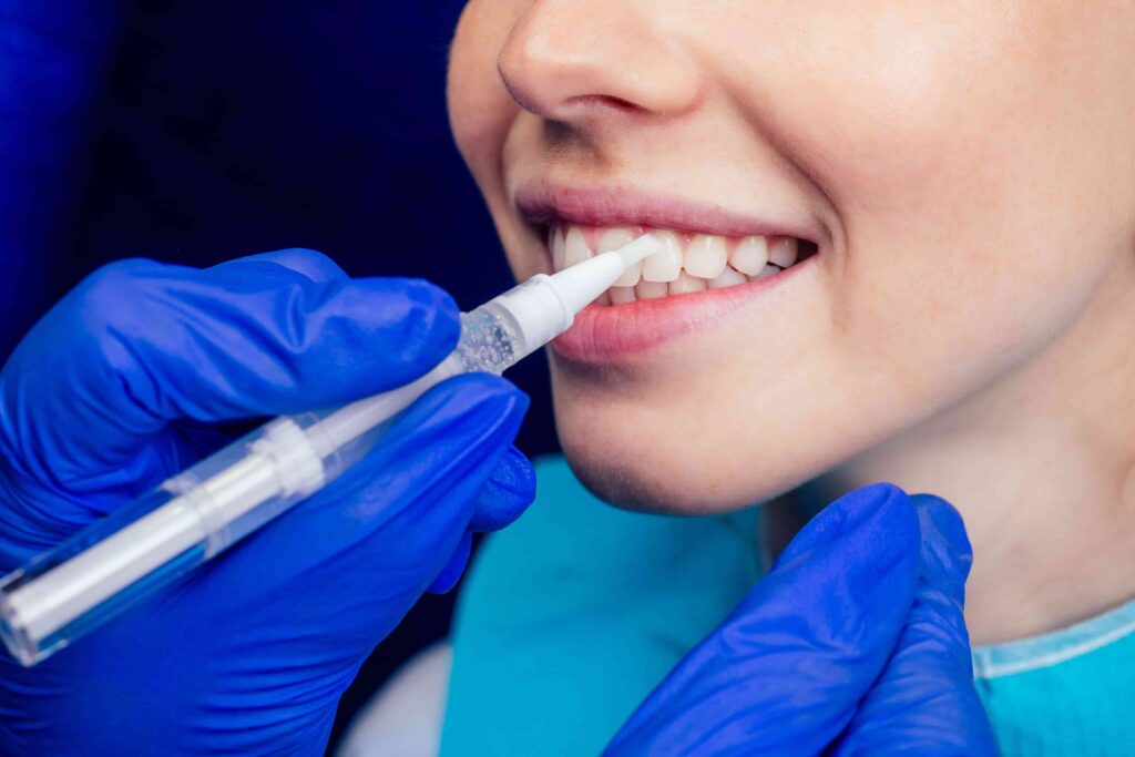 Dental Veneers types