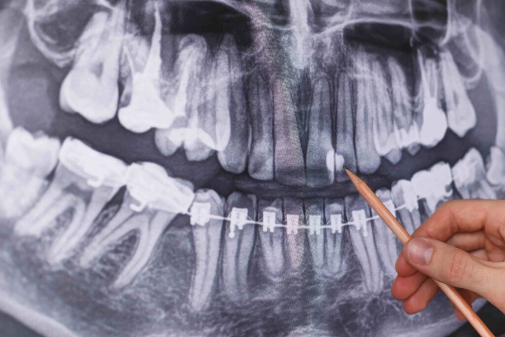 Dental X-rays in Wangsa Maju