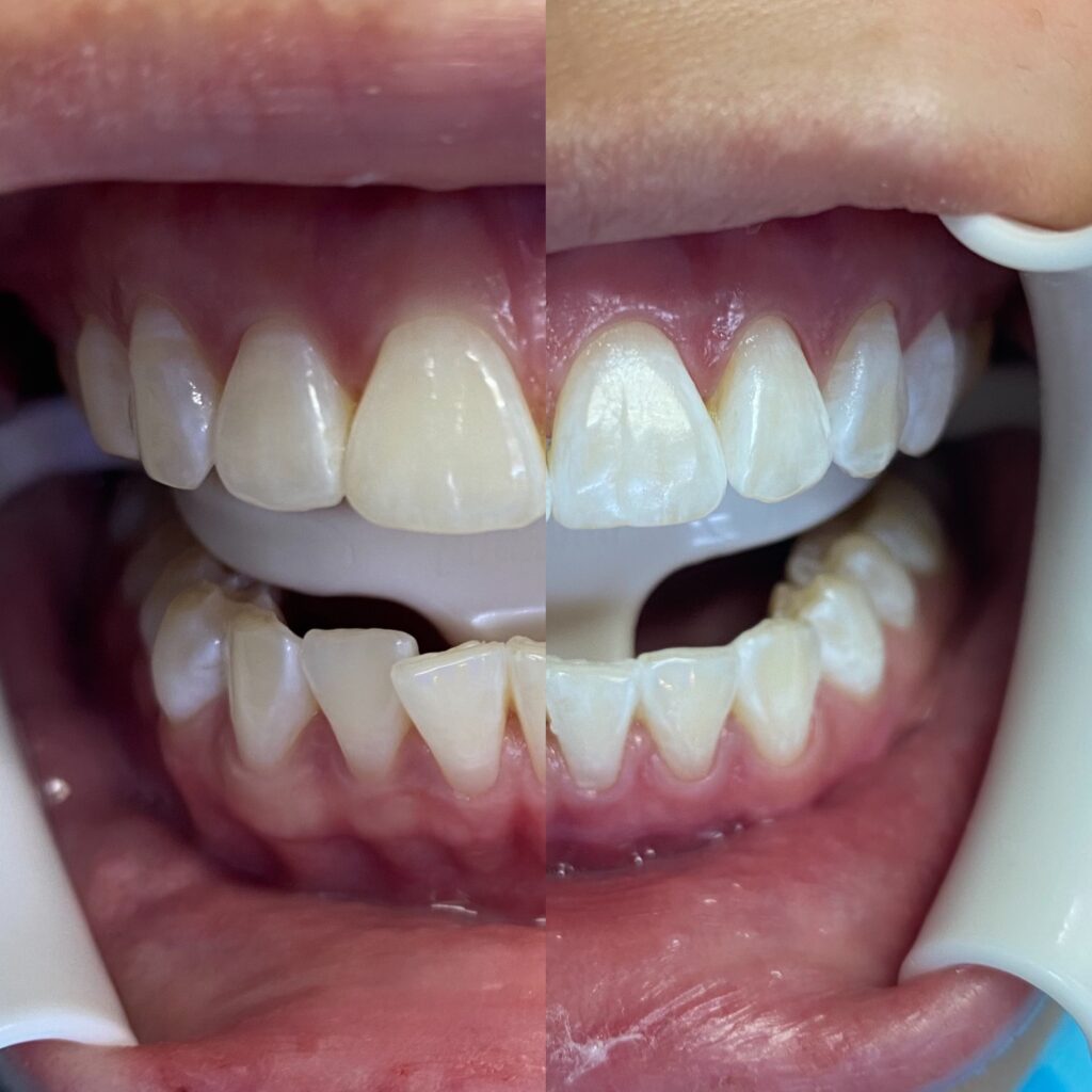 Teeth Whitening cost in wangsa maju